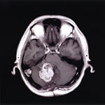 脳腫瘍のMRI像
