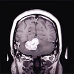 脳腫瘍のMRI像