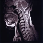 頸椎ヘルニアのMRI像